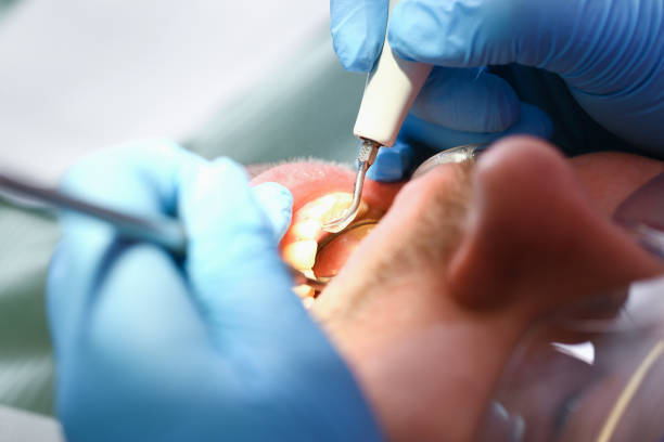 Best Emergency Wisdom Teeth Removal in Sargent, TX