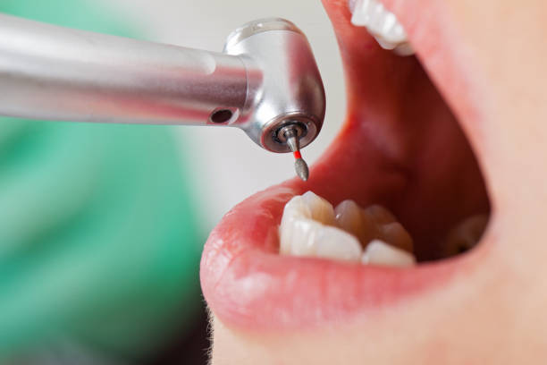 Best Emergency Tooth Extraction in Sargent, TX